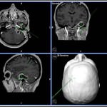 imagen-neuronavegador-meurinoma-trigemino informacion al paciente - neuronavegador -imagen-neuronavegador-meurinoma-trigemino