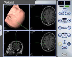 imagen-neuronavegador-zona-motora-de-la-mano informacion al paciente - neuronavegador -imagen-neuronavegador-zona-motora-de-la-mano