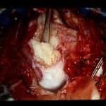 imagen-quirugica-tumor-epidermoide docencia-pregraduados-facultad de medicina uam- imagen-quirugica-tumor-epidermoide