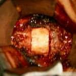 injerto-oseo-en-espacio-intervertebral docencia-pregraduados-facultad de medicina uam- injerto-oseo-en-espacio-intervertebral