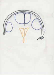 localizacion-de-meningiomas-supratentoriales informacion al paciente -patologia craneoencefalica-meningiomas-localizacion de meningiomas supratentoriales