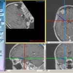 localizacion-puntoero-neuronavegador-amigdala informacion al paciente - neuronavegador -localizacion-puntoero-neuronavegador-amigdala