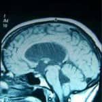 malformacion-chiari-tipoI-A docencia-pregraduados-facultad de medicina uam- malformacion-chiari-tipoI-A