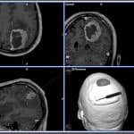 meningioma-en-neuronavegador informacion al paciente - meningioma-en-neuronavegador