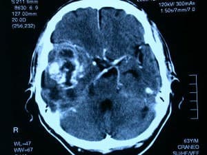 necrosis-muerte-celular informacion al paciente-patologia craneoncefalica-gliomas-necrosis