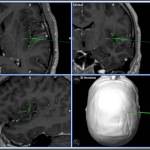 neuronavegador-localizando-lesion-acceso-cisura-sylvio informacion al paciente - neuronavegador -localizando-lesion-acceso-cisura-sylvio