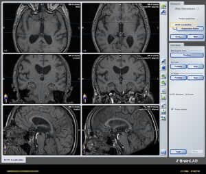 neuronavegador-planificacion-localizando-linea-referencia informacion al paciente - neuronavegador -neuronavegador-planificacion-localizando-linea-referencia