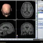 neuronavegador-trayectoria-electrodos-a-implantar informacion al paciente - neuronavegador -neuronavegador-trayectoria-electrodos-a-implantar