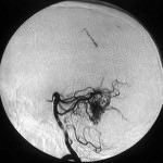 pruebas-diagnosticas-neuralgia-no-esencial-trigemino Información al paciente-neurocirugia funcional-pruebas-diagnosticas-neuralgia-no-esencial-trigemino