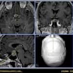 punto-neuronavegador-en-silla-turca-zona-tumoral informacion al paciente - neuronavegador - punto-neuronavegador-en-silla-turca-zona-tumoral