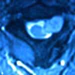 rm-axial-cervical-neurinoma-agujero-conjuncion docencia-pregraduados-facultad de medicina uam- rm-axial-cervical-neurinoma-agujero-conjuncion