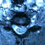 rm-axial-compresion-medular-por hernia-discal docencia-pregraduados-facultad de medicina uam- rm-axial-compresion-medular-por hernia-discal