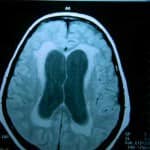 rm-axial-edema-transependimario docencia-pregraduados-facultad de medicina uam- rm-axial-edema-transependimario