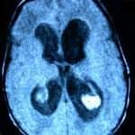 rm-axial-hidrocefalia-hemorragia-intraventricular docencia-pregraduados-facultad de medicina uam- rm-axial-hidrocefalia-hemorragia-intraventricular