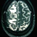 rm-axial-metastasis-parietal docencia-pregraduados-facultad de medicina uam- rm-axial-metastasis-parietal