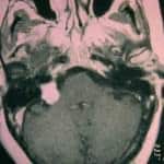 rm-axial-neurinoma docencia-pregraduados-facultad de medicina uam- rm-axial-neurinoma