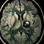 rm-cerebral-angioma-cavernoso docencia-pregraduados-facultad de medicina uam- rm-cerebral-angioma-cavernoso