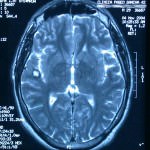 rm-cerebral-cavernoma-cisura-sylvio informacion al paciente - neuronavegador -rm-cerebral-cavernoma-cisura-sylvio