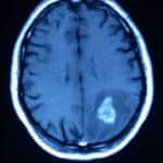 rm-cerebral-glioma-alto-grado docencia-pregraduados-facultad de medicina uam- rm-cerebral-glioma-alto-grado