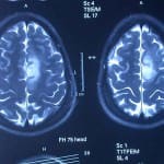 rm-cerebral-lesion-prerolandico-izquierdo informacion al paciente - neuronavegador -rm-cerebral-lesion-prerolandico-izquierdo