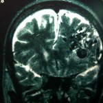 rm-cerebral-multiples-dilataciones-vasculares docencia-pregraduados-facultad de medicina uam- rm-cerebral-multiples-dilataciones-vasculares
