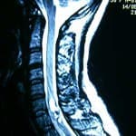 rm-cervical-angioma-cavernoso docencia-pregraduados-facultad de medicina uam- rm-cervical-angioma-cavernoso