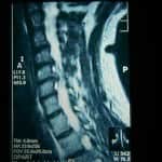 rm-cervical-estenosis-canal-osteofitos docencia-pregraduados-facultad de medicina uam- docencia-pregraduados-facultad de medicina uam-