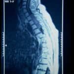 rm-columna-ependimoma-columna docencia-pregraduados-facultad de medicina uam- rm-columna-ependimoma-columna