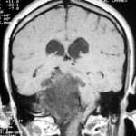 rm-control-lesiones-nervio-trigemino Información al paciente-neurocirugia funcional-neuralgia-del-trigemino-rm-control-lesiones-nervio-trigemino