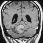 rm-coronal-ependimoma-iv-ventriculo docencia-pregraduados-facultad de medicina uam- rm-coronal-ependimoma-iv-ventriculo