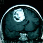 rm-coronal-maningioma-hoz docencia-pregraduados-facultad de medicina uam- rm-coronal-maningioma-hoz