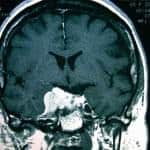 rm-coronal-meningioma-de-base-de-craneo docencia-pregraduados-facultad de medicina uam- rm-coronal-meningioma-de-base-de-craneo