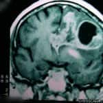 rm-coronal-oligodendroglioma-frontal docencia-pregraduados-facultad de medicina uam- rm-coronal-oligodendroglioma-frontal