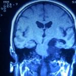rm-coronal-tumor-epidermoide docencia-pregraduados-facultad de medicina uam- rm-coronal-tumor-epidermoide