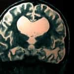rm-craneal--dilatacion-ventricular docencia-pregraduados-facultad de medicina uam- rm-craneal--dilatacion-ventricular
