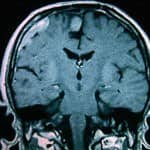 rm-craneal-meningiomatosis docencia-pregraduados-facultad de medicina uam- rm-craneal-meningiomatosis