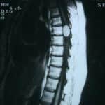 rm-dorsal-meningioma docencia-pregraduados-facultad de medicina uam- rm-dorsal-meningioma