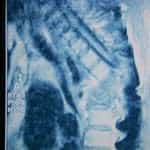 rm-dorsal-paciente-tuberculosis docencia-pregraduados-facultad de medicina uam- rm-dorsal-paciente-tuberculosis