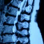 rm-lumbar-estenosis-de-canal docencia-pregraduados-facultad de medicina uam- rm-lumbar-estenosis-de-canal