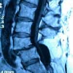 rm-lumbar-listesis-l4-l5 Informacion al paciente-patologia de la columna vertebral-inestabilidad lumbar-rm-lumbar-listesis-l4-l5