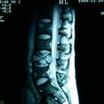 rm-lumbar-metastasis-vertebral docencia-pregraduados-facultad de medicina uam- rm-lumbar-metastasis-vertebral