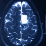 rm-postcirugia-zona-ocupada-por-lcr informacion al paciente - neuronavegador -rm-postcirugia-zona-ocupada-por-lcr