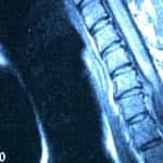 rm-sagital-compresion-medular-por hernia-discal docencia-pregraduados-facultad de medicina uam- rm-sagital-compresion-medular-por hernia-discal