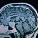 rm-sagital-craneofaringioma docencia-pregraduados-facultad de medicina uam-rm-sagital-craneofaringioma