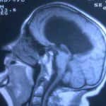 rm-sagital-hidrocefalia-por-estenosis-acueducto docencia-pregraduados-facultad de medicina uam- rm-sagital-hidrocefalia-por-estenosis-acueducto