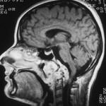 rm-sagital-lesion-clivus-cordoma docencia-pregraduados-facultad de medicina uam- rm-sagital-lesion-clivus-cordoma
