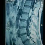 rm-sagital-lumbar-neurinoma docencia-pregraduados-facultad de medicina uam- rm-sagital-lumbar-neurinoma
