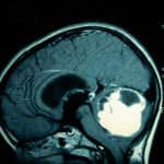 rm-sagital-meduloblastoma docencia-pregraduados-facultad de medicina uam- rm-sagital-meduloblastoma