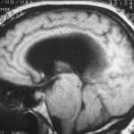 rm-sagital-tumor-produce-hidrocefalia docencia-pregraduados-facultad de medicina uam- rm-sagital-tumor-produce-hidrocefalia