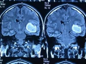 rm-tumor-region-temporal informacion al paciente-patologia craneoncefalica-gliomas-rm de tumor en region temporal
